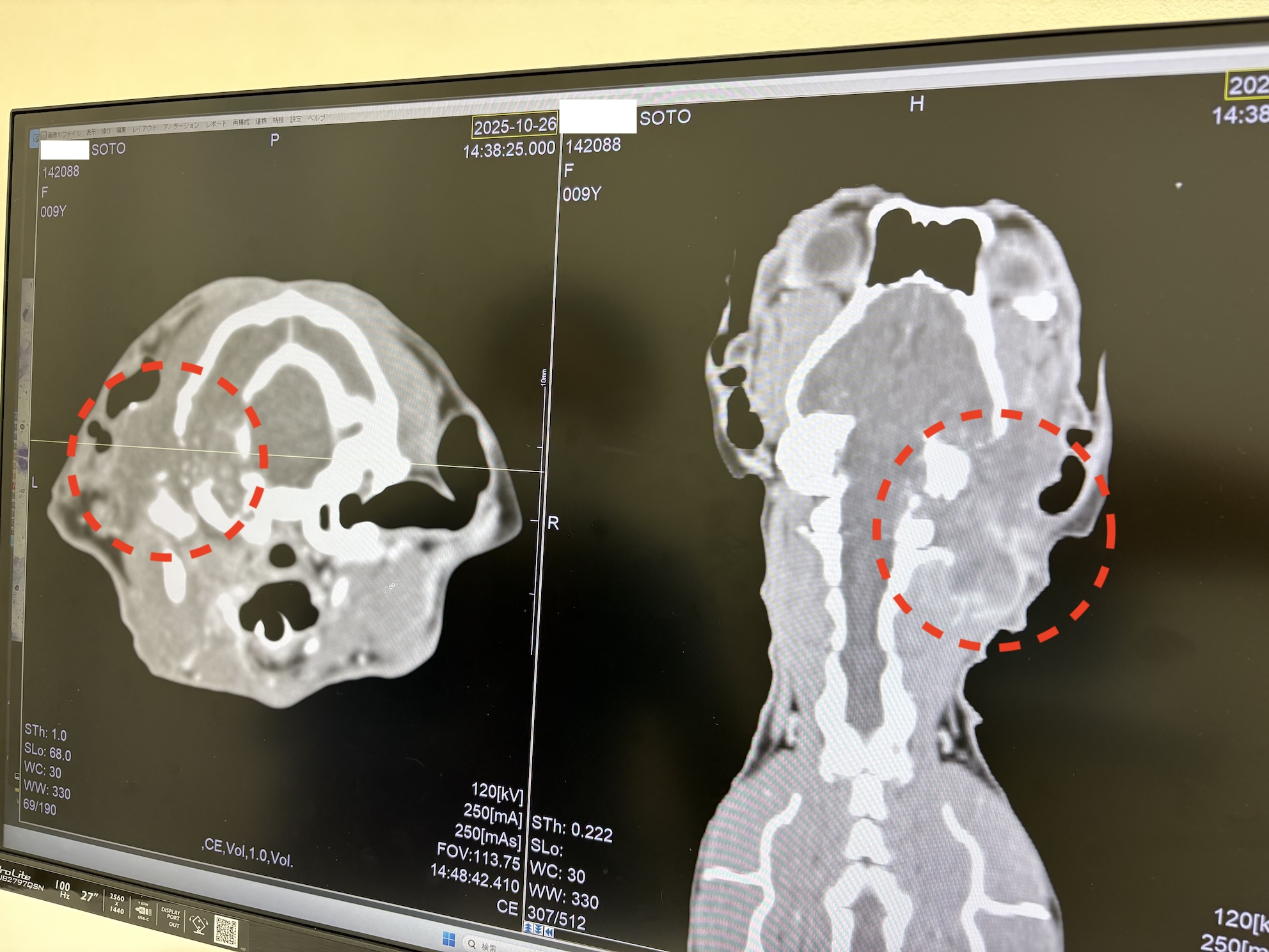 丸で囲った箇所が病変で、頭蓋内にも広がっている